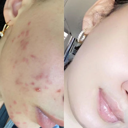 Acne Scar Removal Cream